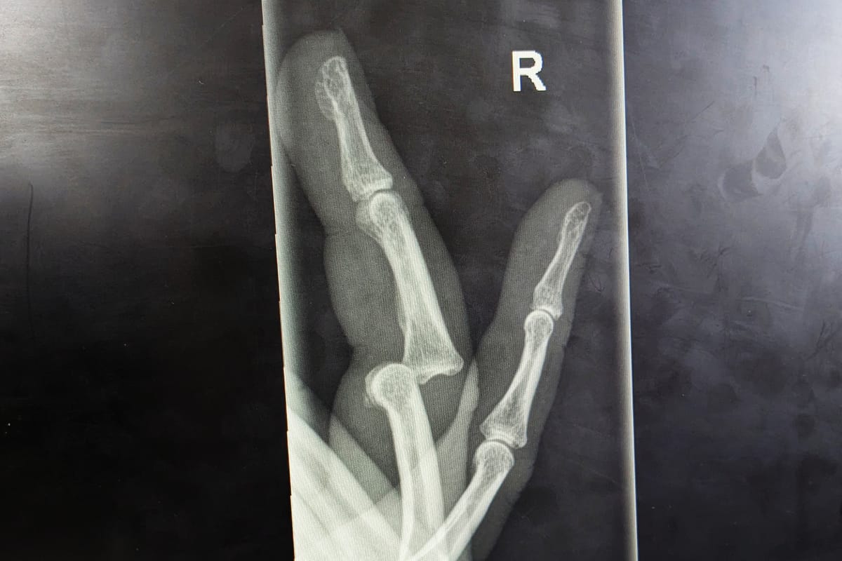 Photo of a screen showing an x-ray of my hand with the fingers dislocated